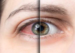 خشکی چشم یا (Dry Eye Syndrome) و راهکارهای مقابله با آن